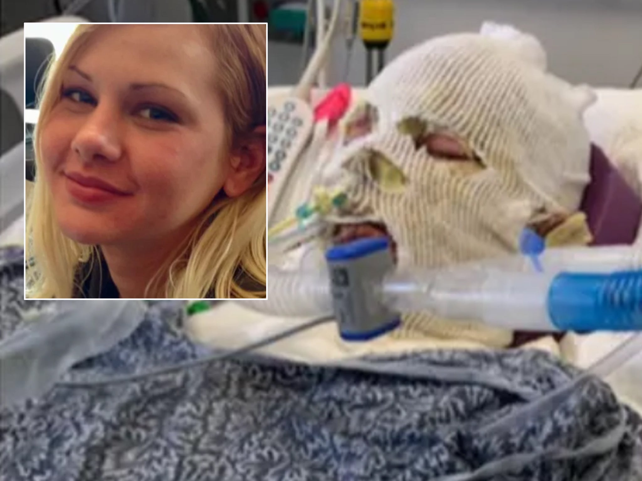 Woman set on fire in attack will ‘never have face she was born with